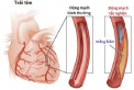 Bệnh mạch vành và những điều cần biết